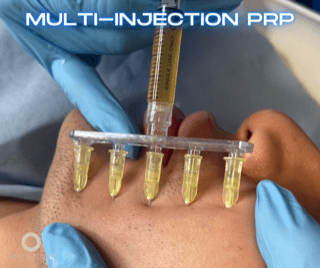 Multi Injection PRP